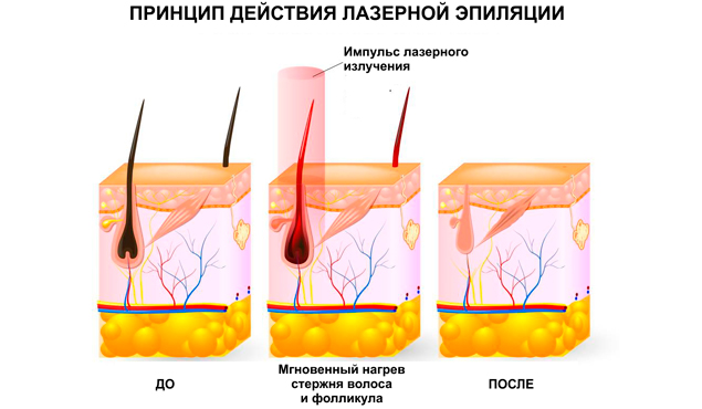 Действие лазерного эпилятора